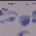 Κυτταρο ενδοτραχήλου με διογκωμένο πυρήνα